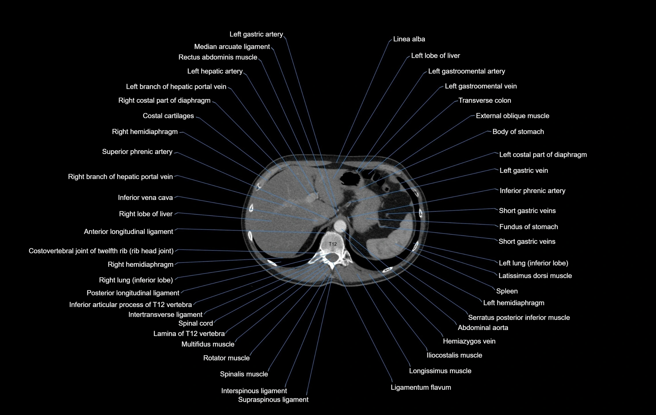CT chest (thorax) soft tissue window labelled axial cross sectional anatomy radiology image-00114.webp